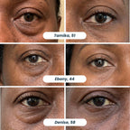 Microneedle Patches | New Generation