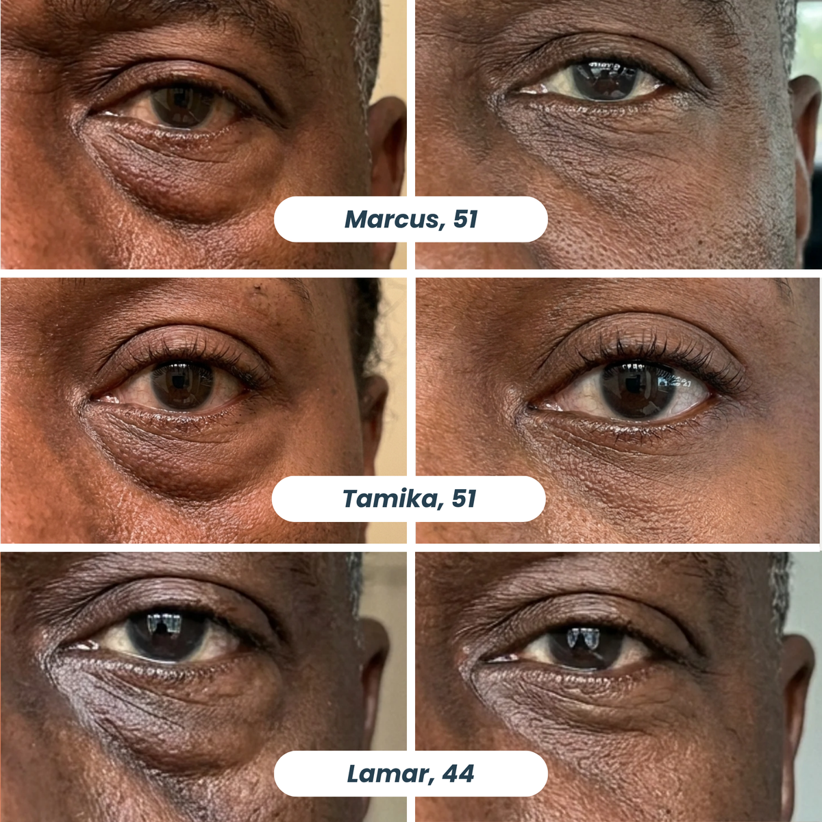 Microneedle Patches | New Generation